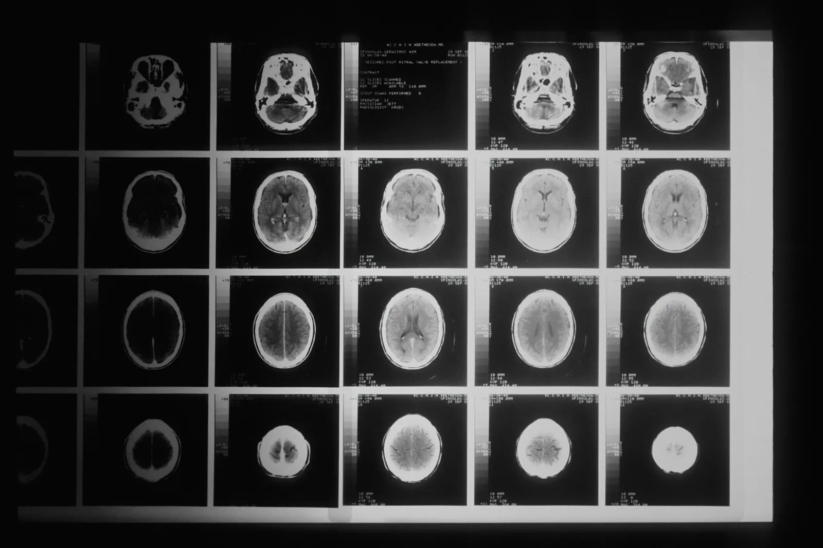 Estenosis aórtica severa y esperanza de vida: la cifra que te ha asustado es de 1955